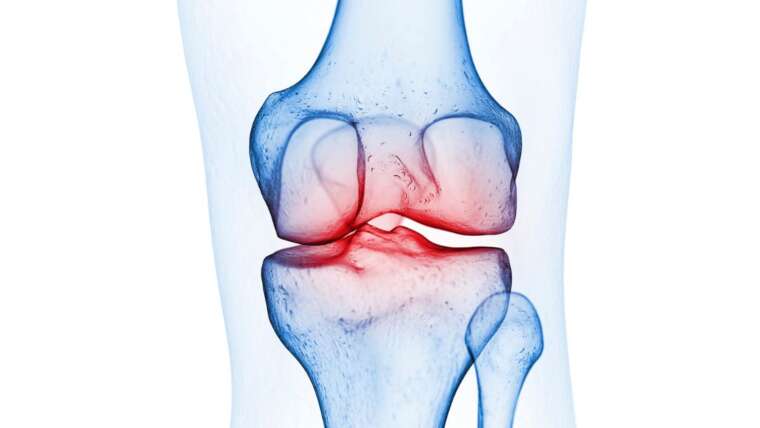 Qual o melhor colágeno para artrose no joelho: descubra aqui!